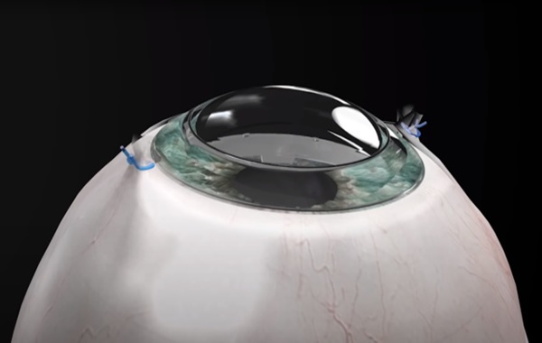 Görme Engelli Birey