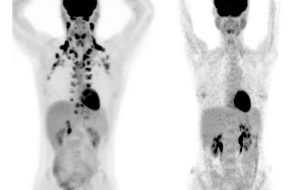 Study of 50.000 people finds brown fat may protect against numerous chronic diseases