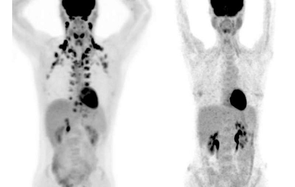 Study of 50.000 people finds brown fat may protect against numerous chronic diseases