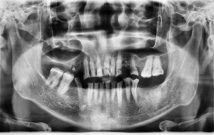 Kemikleri Eriyip Dişleri Dökülene Kadar, İçtiği Radyoaktifli Şurubun Ölümcül Olduğunu Bilmiyordu