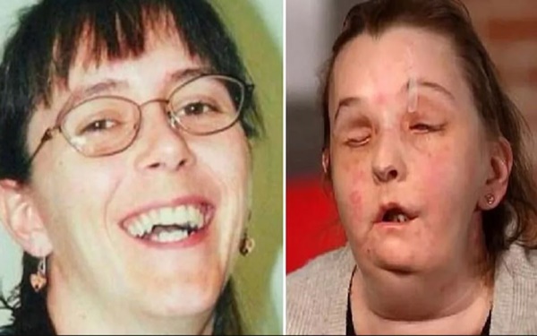 ABDde İki Kez Yüz Nakli