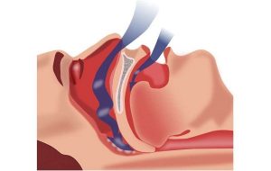 Treating sleep apnea
