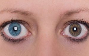 Kimerizm Yüzünden Bir Gözü Kendi Diğer Gözü Doğmamış İkizinin DNAsını Taşıyor
