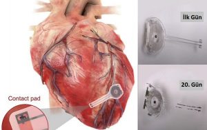 7 Hafta İçinde Çözünen Dünyanın İlk Kablosuz, Pilsiz Kalp Pili Cihazı Geliştirildi