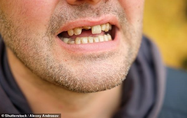 People Beginning to Lose Their Teeth Are More Likely to Have Dementia