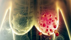 Scientists have killed 95 percent of breast cancer cells