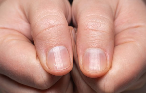 Bir Kişinin Tırnaklarından Koronavirüs Geçirip Geçirmediği Nasıl Belirlenir?