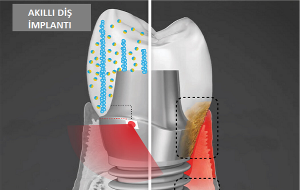 Diş İmplantı Elektrik Üreterek Enfekte Diş Etlerini İyileştirebilir
