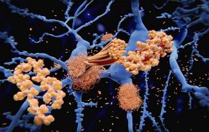 Alzheimer’s Mystery Solved: How Amyloid Beta Forms in Brain Nerve Cells