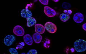 Kanser Hücrelerinin Çeşitli Dokuları İstila Etmek İçin Nasıl Şekil Değiştirdiği Keşfedildi
