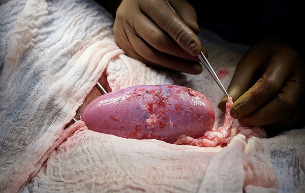 ABDde Domuzdan İnsana