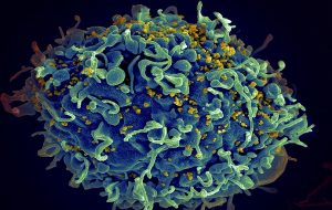 A woman’s own body may have cured her of HIV, study finds