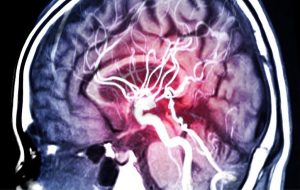 Insomnia Is a Potential Risk Factor for Highly Fatal Brain Aneurysm Rupture