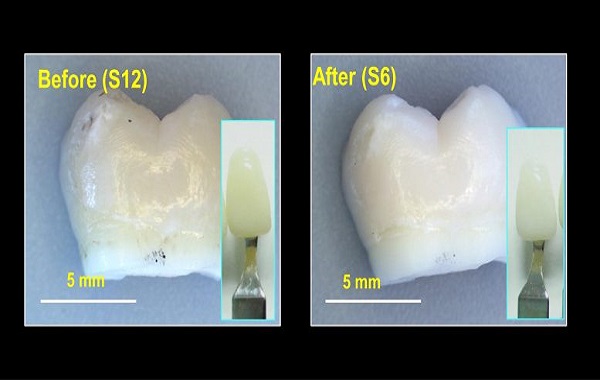 New Dental Bleaching Gel: Whiter Teeth, Without the Burn