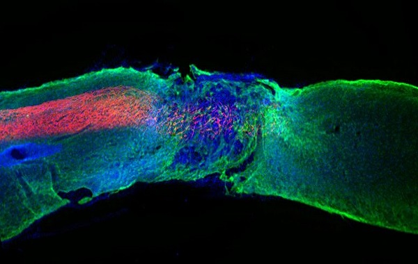 Regenerative Medicine Breakthrough: “Dancing Molecules” Successfully Repair Severe Spinal Cord Injuries