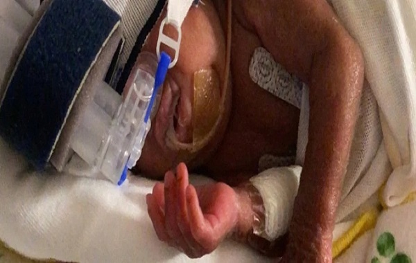Premature Baby With Less Than 1% Survival Chance Officially Breaks The World Record