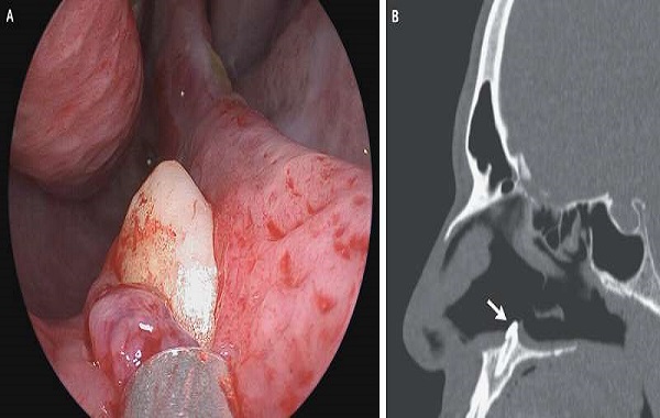 Doctors find tooth growing inside a patient's nose