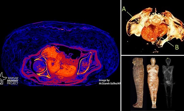 2000 Yıllık Hamile Mumyanın Kemikleri Erimezken Taşıdığı Bebek Nasıl Turşulaştı?/