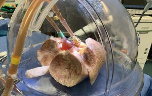 An Enzyme Treatment to Convert Donated Organs to 0 Blood Type Developed