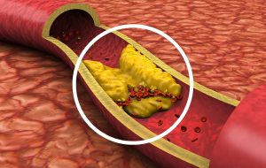 Bilim İnsanlarından Arter Tıkanıklığını Önlemek İçin Yeni Bir Strateji
