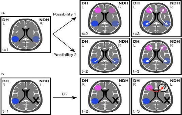Woman with no left temporal lobe developed a language network in the right side of her brain