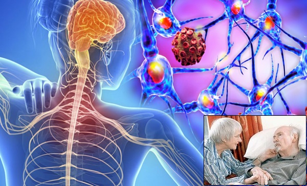 Yeni Bir Tedavi MS Hastalığı İçin Büyük Umut Vaat Ediyor