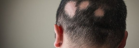 First Pill For Severe Alopecia Areata Hair Loss Given FDA Approval