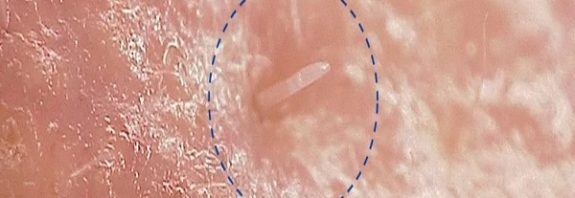 Skin Mites That Mate on Our Faces at Night Are Slowly Merging With Humans