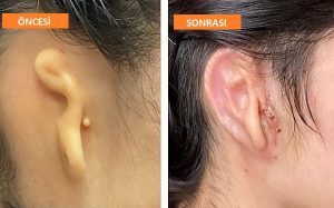 20 Yaşındaki Gence Kendi Hücrelerinden Dünyanın İlk 3D Kulak Nakli Yapıldı