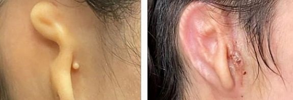 20 Yaşındaki Gence Kendi Hücrelerinden Dünyanın İlk 3D Kulak Nakli Yapıldı