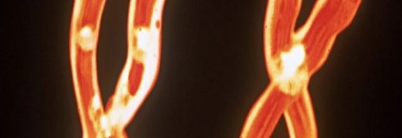 Many Men Lose Y Chromosomes as They Age. Now We May Know Why It's So Deadly