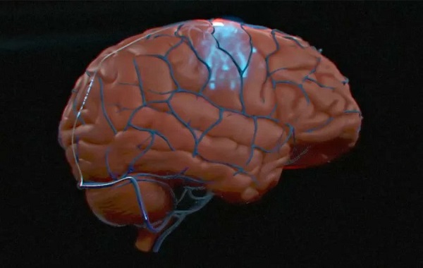 Synchron says it's the first to implant a human brain-computer interface in the US