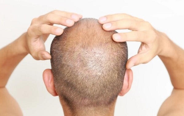 Erkek Tipi Kellikle Savaşmanın Yeni Bir Yolu Bulundu