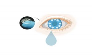 Kanser Teşhis Edebilen Akıllı Kontakt Lens Keşfedildi