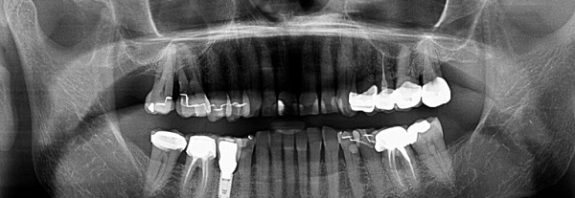False teeth could double as hearing aids