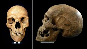 Sadece Erkeklerde Görülen Bir Genetik Durumun En Eski Vakası Keşfedildi