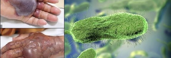 Ian Kasırgası Rekor Düzeyde Et Yiyen Ölümcül Bakteriye Sebep Oldu