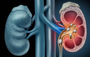 NASA-funded technique allows doctors to remove kidney stones without anesthesia