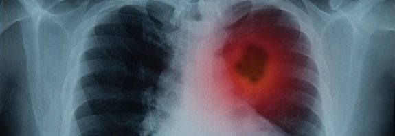 Bilim İnsanları Kanserli Hücrelerin Metastazını Durdurabilecek Bir Atılım Keşfetti