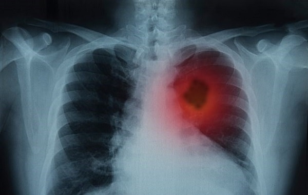 Bilim İnsanları Kanserli Hücrelerin Metastazını Durdurabilecek Bir Atılım Keşfetti