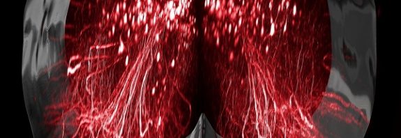 People With Complete Paralysis Walk Again After Nerve Stimulation Breakthrough