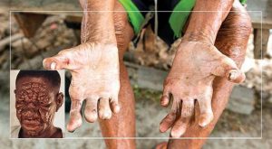 Cüzzamın İnanılmaz Bir Yeteneği Bulundu: Karaciğeri Yenileyebiliyor ve Gençleştiriyor