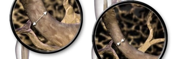 Kemik Erimesini Tedavi Etmek Bir Hap Almak Kadar Kolay Olacak