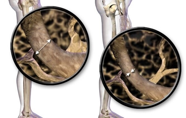 Kemik Erimesini Tedavi Etmek Bir Hap Almak Kadar Kolay Olacak