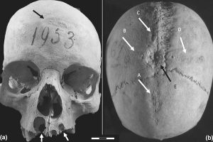 Orta Çağ İtalyasında Kafatası Ameliyatı Yaptırmak