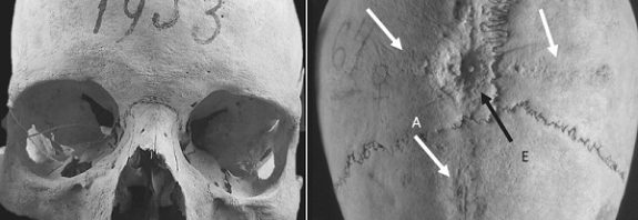 Orta Çağ İtalyasında Kafatası Ameliyatı Yaptırmak