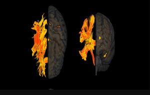 Yüksek Kan Basıncı
