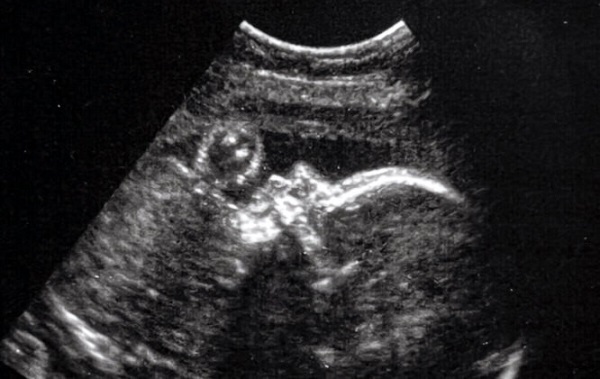 Cerrahlar Anne Karnındaki Bir Çocuğa Beyin Ameliyatı Yaptı