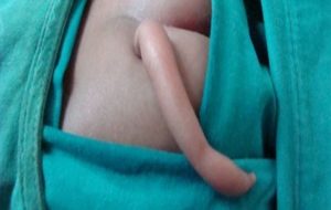 Some Babies Are Born With 'Tails', But Not For The Reason You Might Think