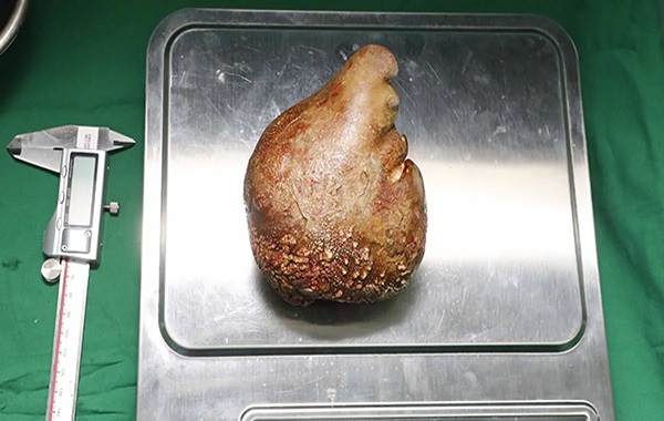 The World's Largest Kidney Stone Has Just Been Removed From A Man In Sri Lanka